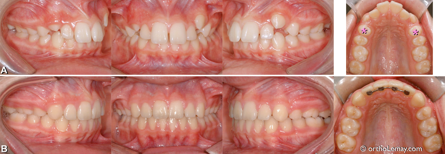 Malocclusion classe 2 division 1 traitée en orthodontie avec l'extraction de 2 prémolaires. 