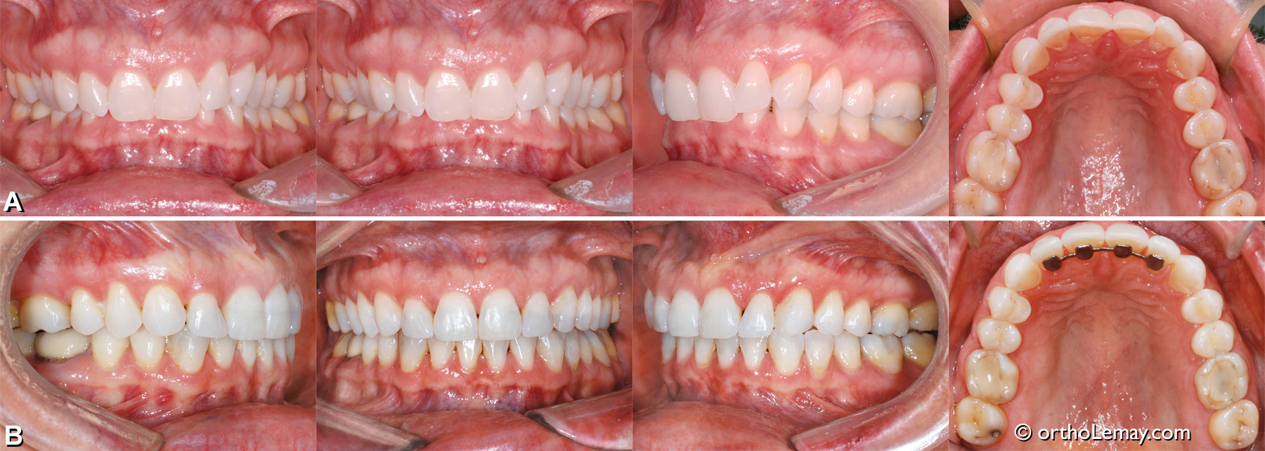 Sévère malocclusion dentaire classe II division 2 avec overbite à 100 % et incisives basculées vers l'intérieur. Traitement d'orthodontie sans extractions ou chirurgie 