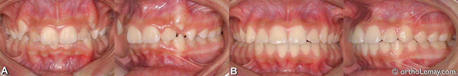 Malocclusion classe 2 division 2 (II) avec overbite important et canines non fonctionnelles. 