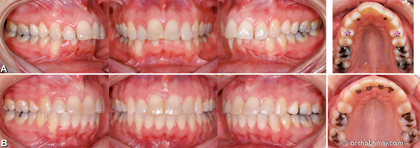 Sévère malocclusion dentaire classe 2 division 1 traitée avec des extractions chez une adulte. 