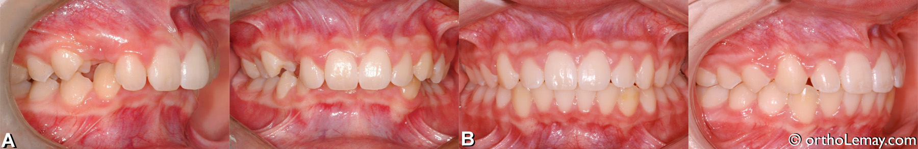 malocclusion classe 2 division 1 avec overbite et overjet excessifs traitée en orthodontie. Adolescent. 