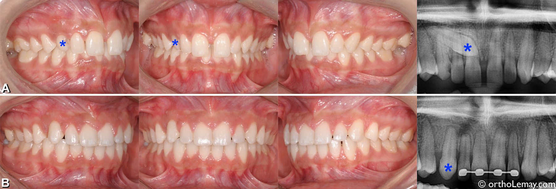 Malocclusion classe 2 division 2 adulte avec canine incluse palatine. Traitement d'orthodontie pour tracter la canine et corriger la malocclusion 