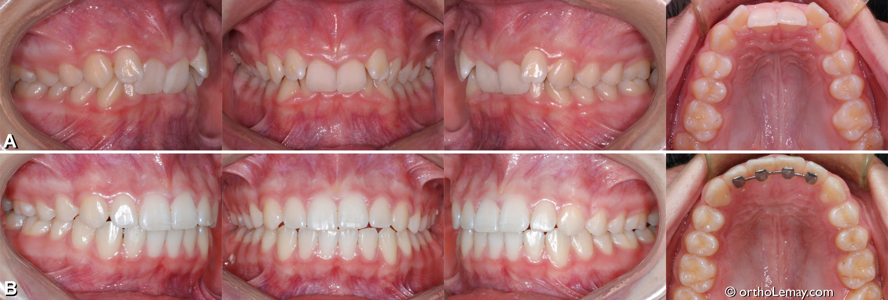 Malocclusion classe 2 division 2 avec supraclusion excessive, encombrement dentaire, rotations. Traitement d'orthodontie adolescent. 