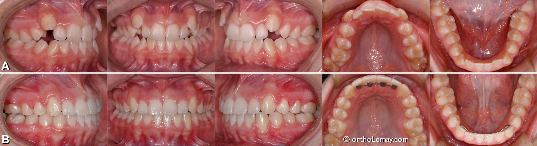 malocclusion dentaire CL1 arcade étroite canine ectopique traitement orthodontie Sherbrooke MPL13f 123204