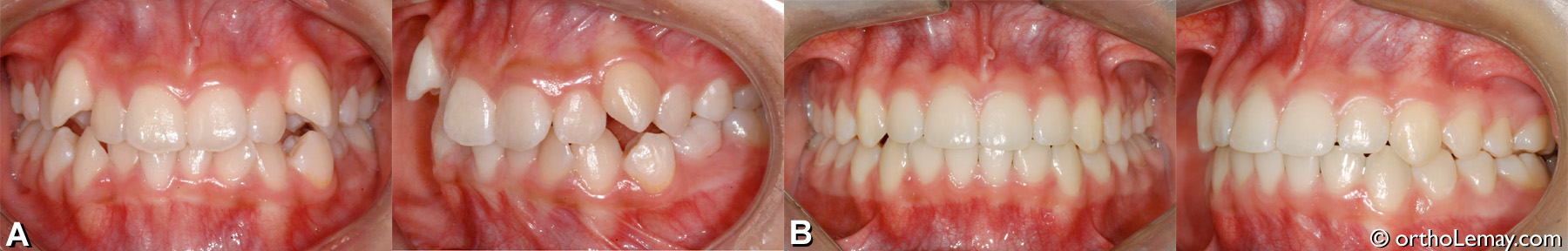 malocclusion dentaire classe 1 , classe I, canines ectopiques, arcades étroites. Correction orthodontiques