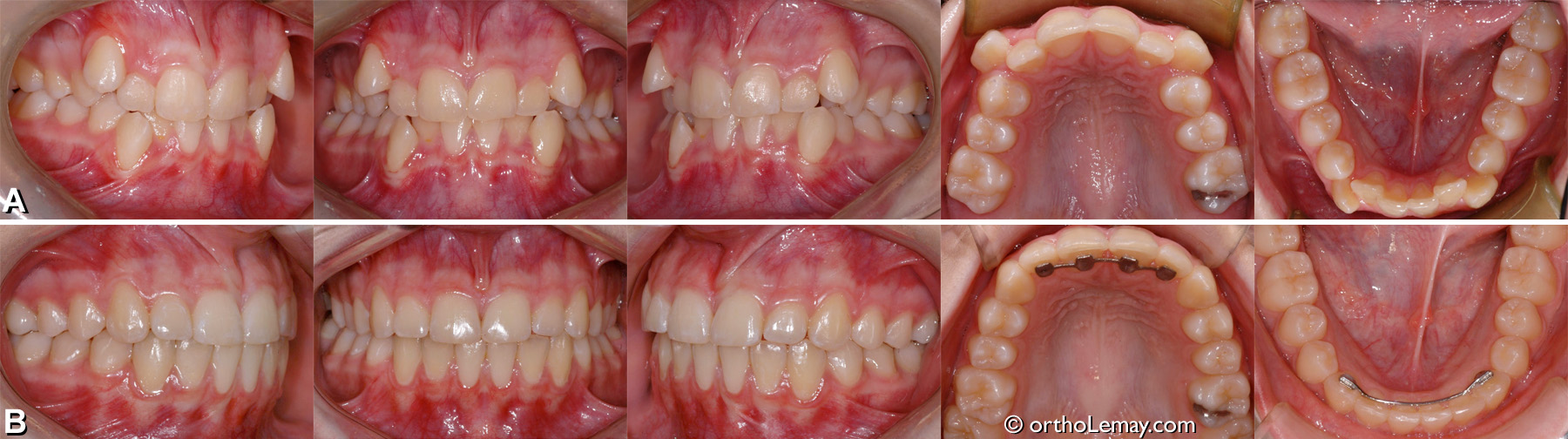 ùmoo dentaire classe 1 chevauchement dentaire, dental crowding expansion orthodontique en orthodontie 