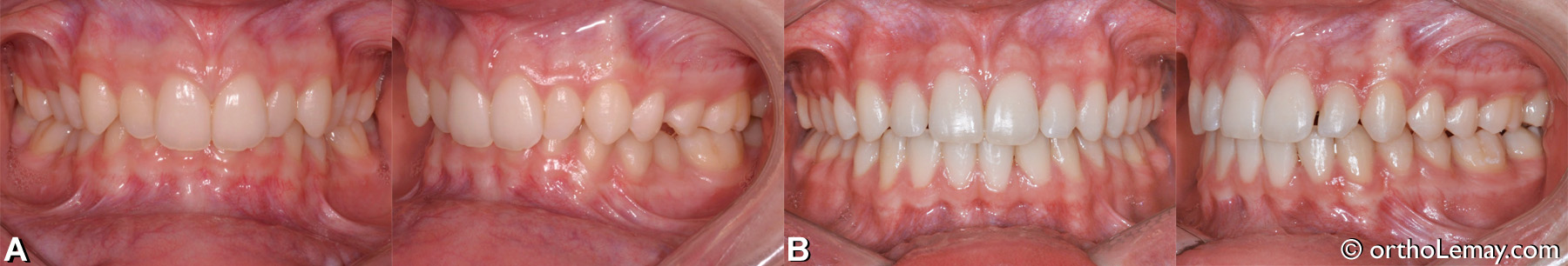 Malocclusion dentaire classe 2, supraclusion, overbite excessif, latérales étroites.