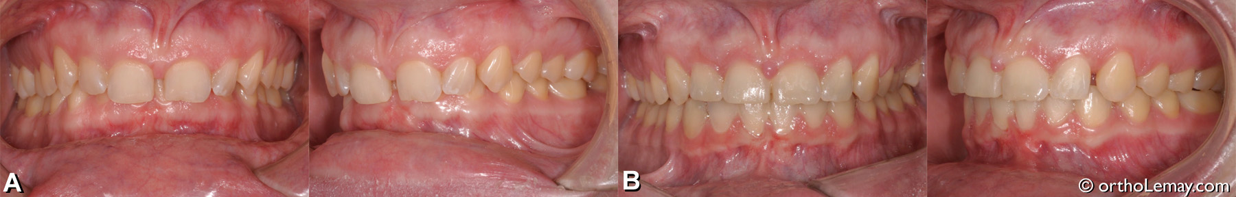 Malocclusion dentaire classe 2 division 2 adulte avec usure dentaire et overbite 100% de surplomb vertical. 