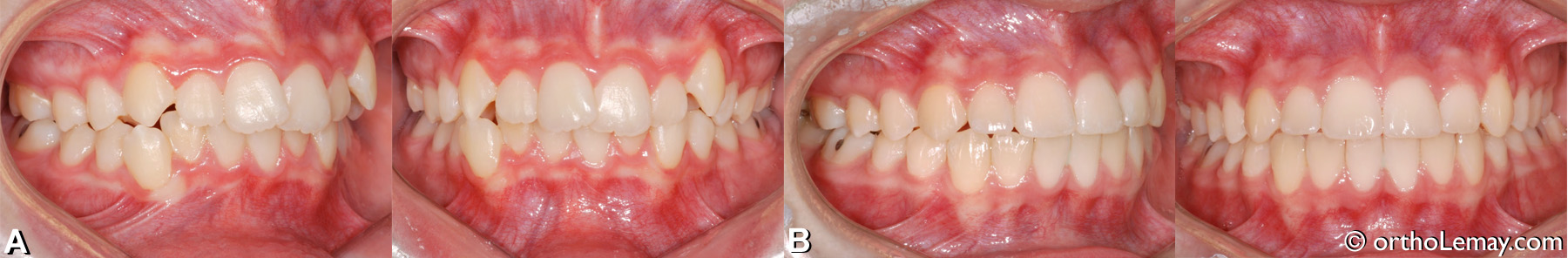 Correction en orthodontie d'une malocclusion dentaire classe 2 (II) avec chevauchement dentaire et déviation les lignes médianes chez un adolescent. 