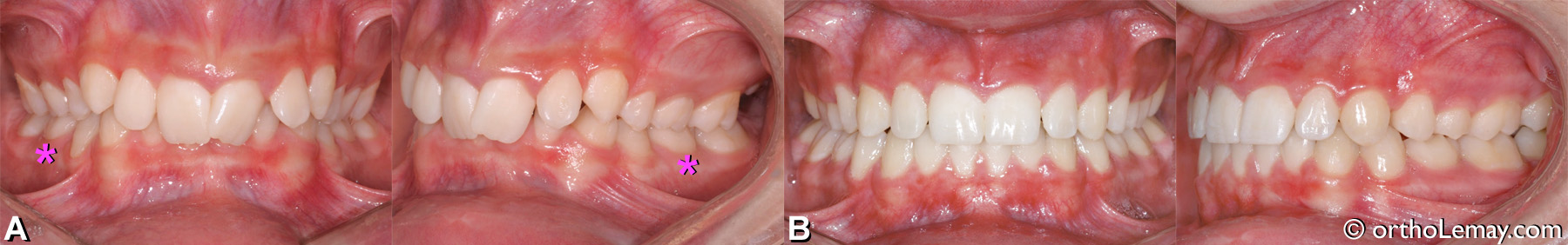 malocclusion dentaire classe 2 division 2 anodontie premolaire orthodontie Sherbrooke MG14m 133032