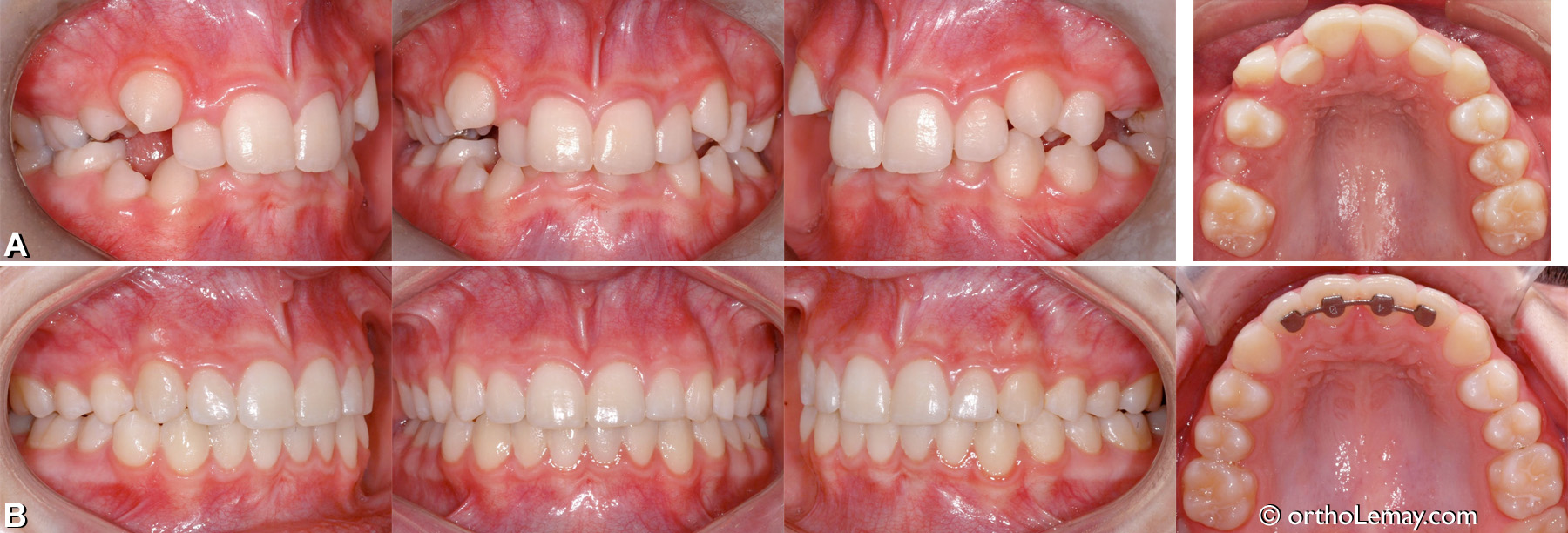 Malocclusion dentaire classe 2, chevauchement dentaire, supraclusion antérieure.