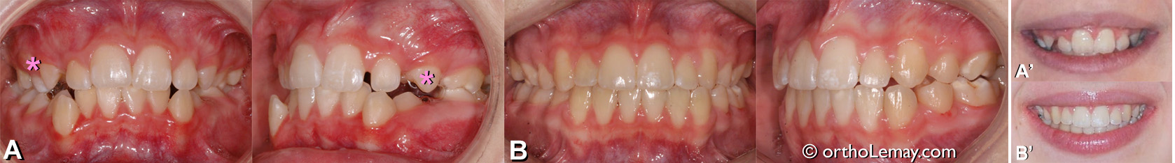 Malocclusion dentaire classe 2 traitée avec des extractions en orthodontie. Orthodontiste Sherbrooke 