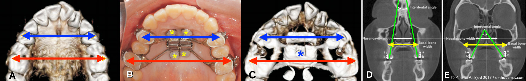 MARPE EPRAC RPE mini screw expansion maxillaire palatine orthodontie Lemay