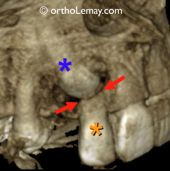 Canine incluse CBCT resorption radiculaire orthodontie CBCT TVFC scan 3D